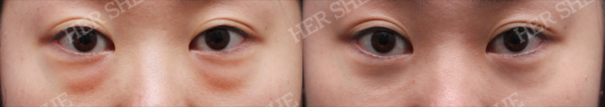 eye bag removal