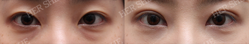 eye bag removal