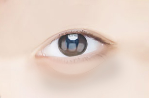 fat under the eyes