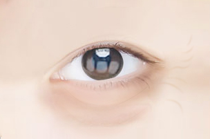 fat under the eyes