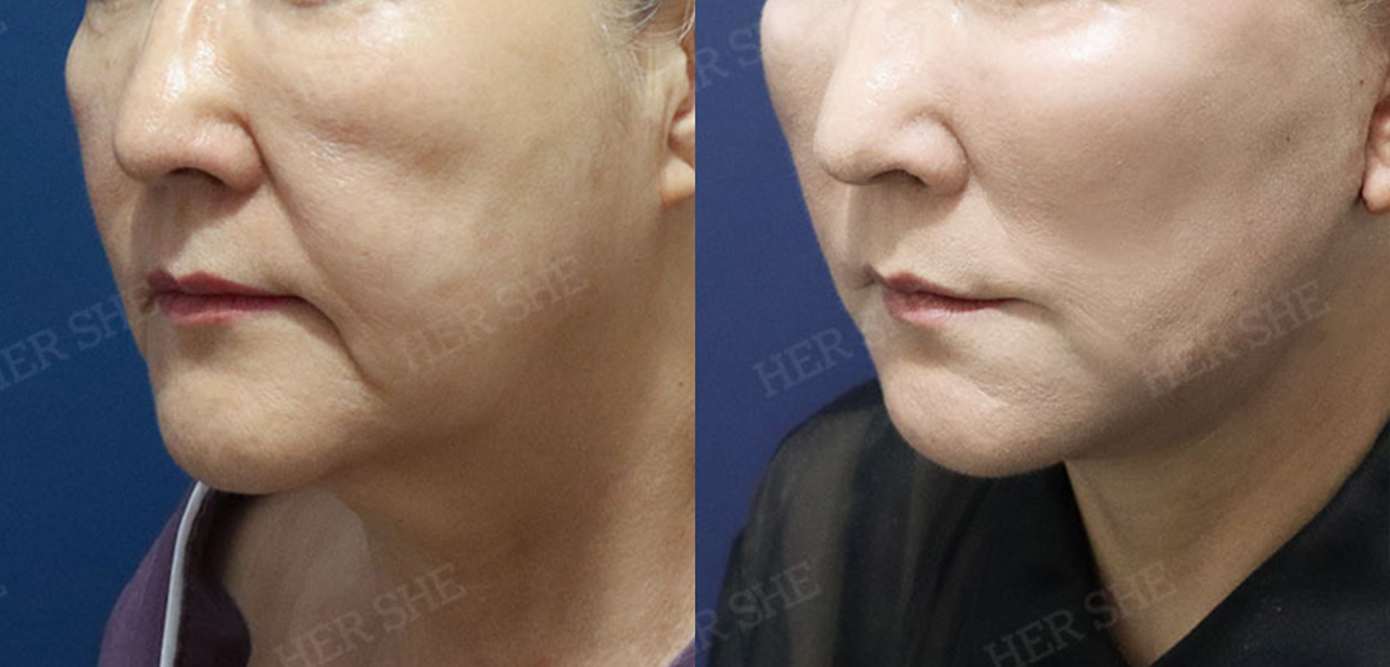 Shoulder Contouring Before & After Comparison