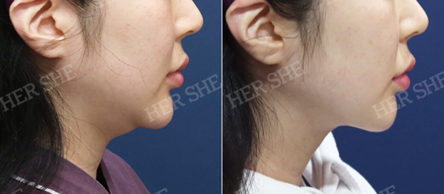 Before and after