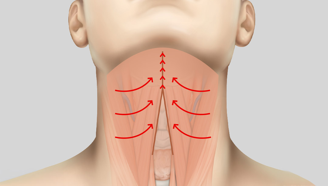 Removing Clustered Fat, a Cause of a Heavy Double Chin