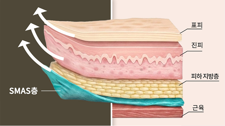 Improve and Maintain Lifting by Securing the SMAS Layer