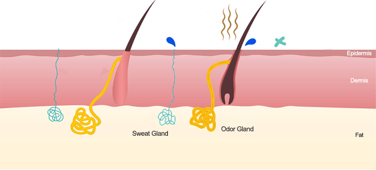 miraDry treatment mechanism